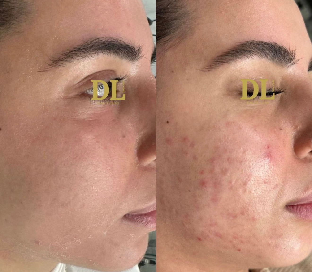 ערכת הרגעת אקנה - DL ACNE CALM KIT